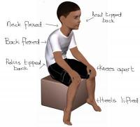 Poor sitting posture in a child with low muscle tone 